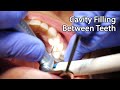 Dental Filling Procedures and Techniques