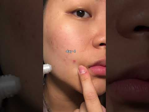 SOS acne calming cream⚠️ #skincare