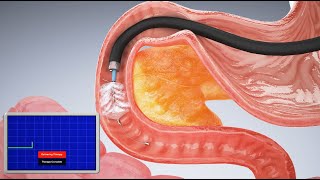 Groundbreaking vapor ablation technology procedure - 3d animation