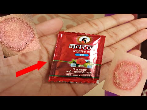 दाद खाज खुजली कितना भी पुराना हो यह तेल लगा लो एक ही दिन में छुट्टी कर देगा,fungal ringworm oil