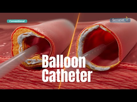 Serranator® Balloon Catheter for PAD Treatment | Serration Angioplasty Explained in 3D