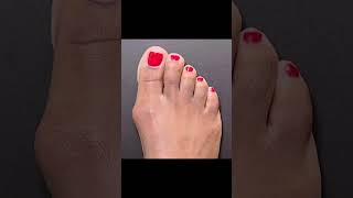 MINIMALLY INVASIVE BUNION SURGERY WITHOUT PINS OR SCREWS 🙌🏼#shorts #bunions