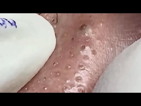 Blackheads & Whiteheads Satisfying Removal @0340