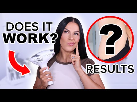 I TRIED THE WORLD'S FIRST AT HOME LASER DEVICE...THESE ARE MY RESULTS!