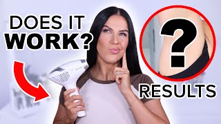 I TRIED THE WORLD'S FIRST AT HOME LASER DEVICE...THESE ARE MY RESULTS!