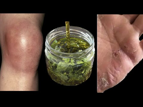Bu yağ egzamayı cildinizden siler. Kızarıklık ve cilt kaşıntısı geçer. Varisli damarlar ve ağlar