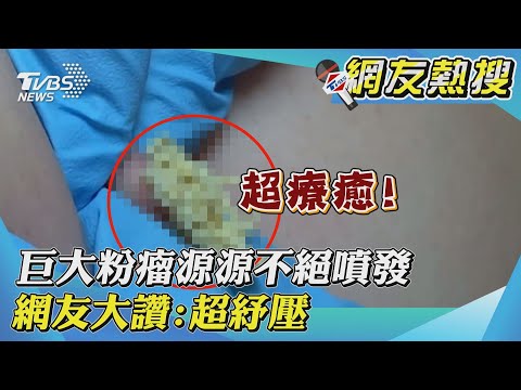 【網友熱搜】巨大粉瘤源源不絕噴發 網友大讚:超紓壓!｜sebaceous cyst｜TVBS新聞