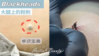 大腿上的粉刺 (blackheads on leg)  - Taiwan Tainan台南清粉刺最乾淨