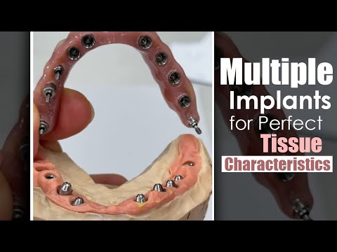 Multiple Implants for Perfect Tissue Characteristics