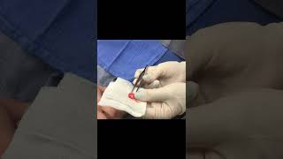 A Near Ear Cyst Squeeze