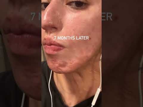 scars fade | #selflove #motivation #gym #viral #viralvideo #transformation #fy #fyp #fypage #shorts