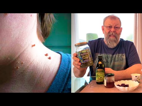 О чем расскажут папилломы и чего нельзя делать категорически