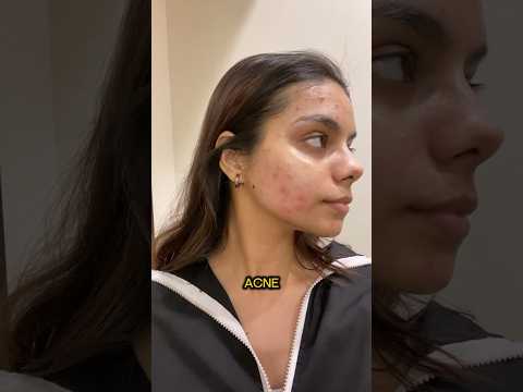 Laser treatment for Acne Scars ‼️ is it worth it? Check description for details #youtubeshorts