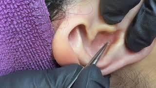 耳朵裡的小粉刺 Small Ear Blackhead