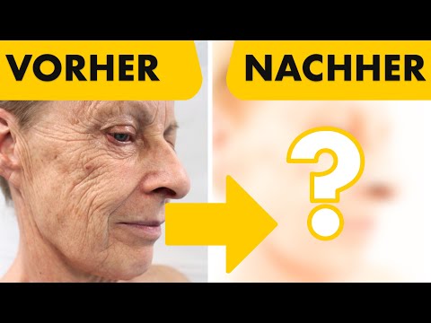 Mein bestes Facelift aus 3000 OP's! 5 Eingriffe in nur einer OP | Facelift, Halslift, Augenlider...