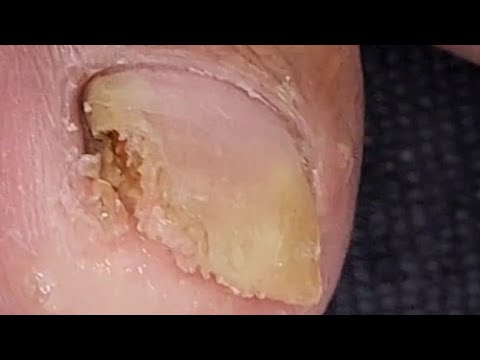 Monster Nail