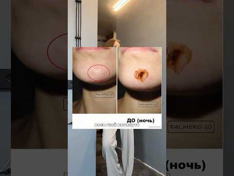 Ихтиоловая мазь готовится из ПРОТУХШИХ РЫБ?! Арт: 142054898 #прыщи #бьюти #прыщи #ихтиол