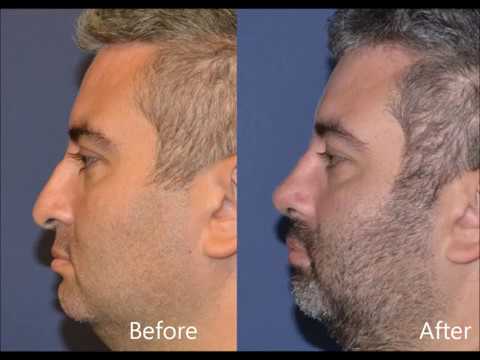 Before and after facial profile comparison.