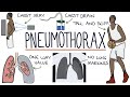 Pneumothorax Diagnosis and Management