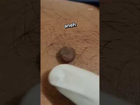 Jangan Mencabut Bintil