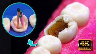¿Cómo salvar una muela y evitar la extracción?