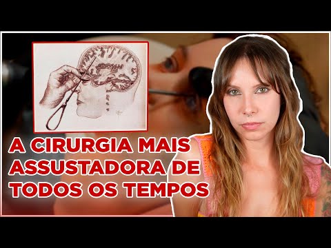 Lobotomia: a cirurgia terrivel que virou moda em 1940