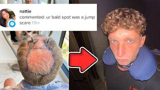 They can't call me bald anymore [FUE Hair Transplant in Turkey]
