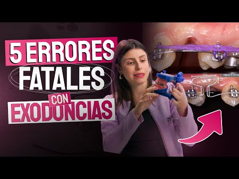 5 errores FATALES que arruinan un tratamiento con EXODONCIAS