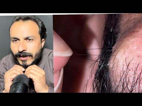 ASMR beard hair relaxing video sleep face | new microphone 🎤 | ingrown hair satisfying