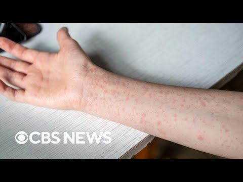 YouTube video thumbnail: U.S. Measles Numbers Reach Highest Levels in 33 Years