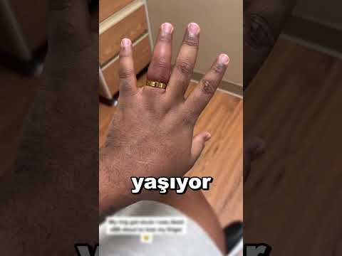 Yüzük Nasıl Çıkarılır 😨