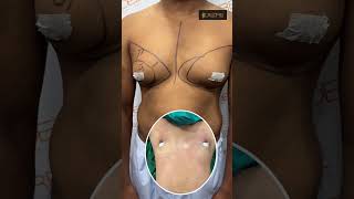 Gynecomastia | Gynecomastia Treatment