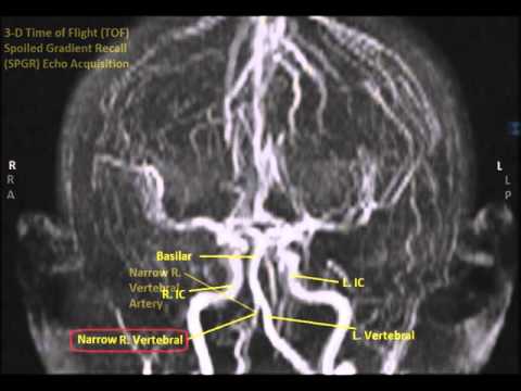 Mra Vertebral Artery Cpt Code - 08/2021