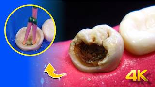 Así es el Tratamiento Para Salvar Dientes