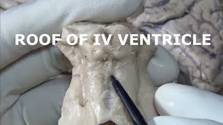 Roof of IV ventricle