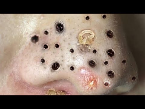 Blackhead Removal With Sac Dep Spa @100074148