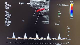Anterior tibial artery vasculitis/arteritis by doppler ultrasound.