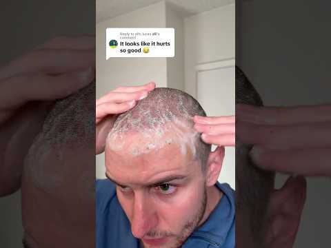 glad that’s over with #hair #hairtransformation #hairtransplant #update #washday #hairwashday #scab