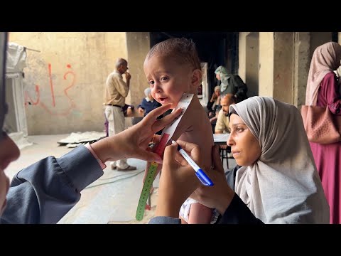 وكالة الغوث "الأونروا" ترعى أطفالاً يعانون من سوء التغذية في مراكز إيواء النازحين بمدينة غزة