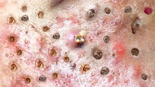 Loan Nguyen Acne Treatment 131c