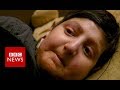 Understanding Moine's Journey with Epidermolysis Bullosa