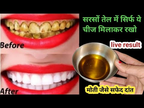 गंदे पीले दांतों को सफेद करने का अनोखा तरीका आज तक आपने नहीं देखा होगा/teeth whitening only Minutes