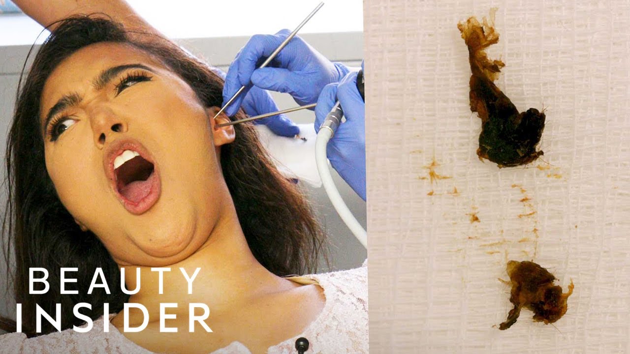 Person experiencing ear cleaning procedure and debris collection.