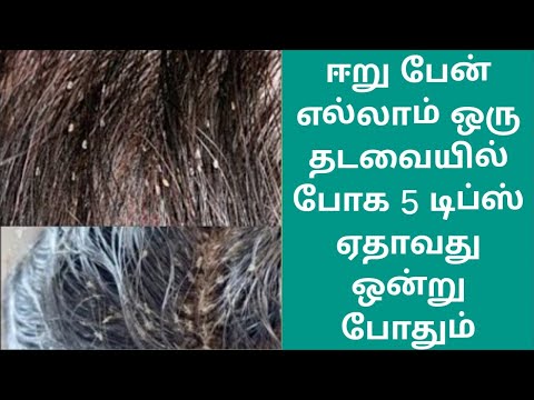 ஈறு பேன் எல்லாம் ஒரு தடவையிலேயே போக 5 டிப்ஸ் ஏதாவது ஒன்று போதும் #homeremedies #usefultips #savings