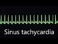 Heart Rate and Rhythm Concepts
