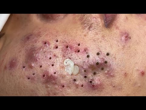 Blackhead Removal With Sac Dep Spa @100074215