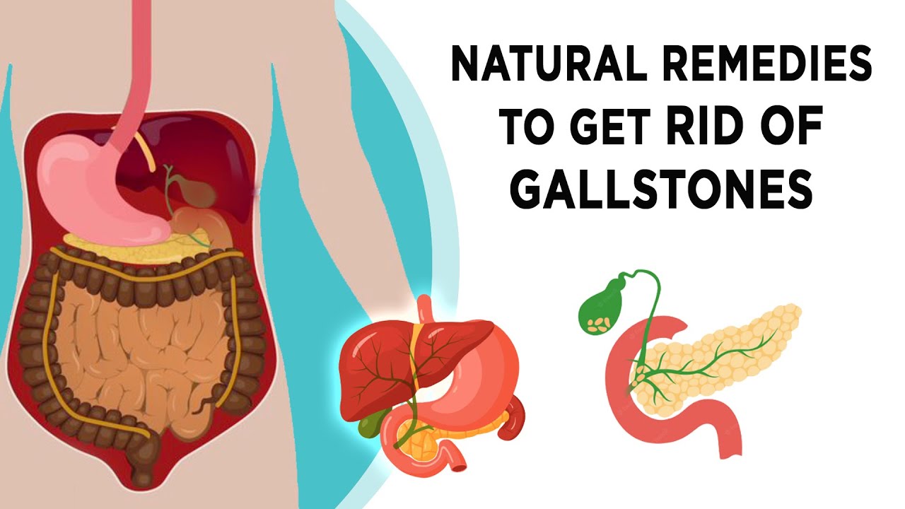 6 Natural Remedies To Get Rid of Gallstones