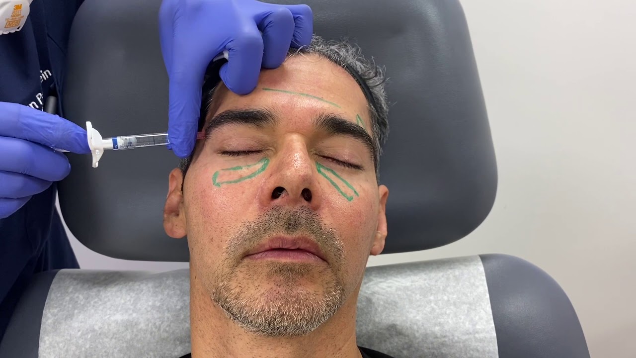 Woman with markings for cosmetic procedure preparation.