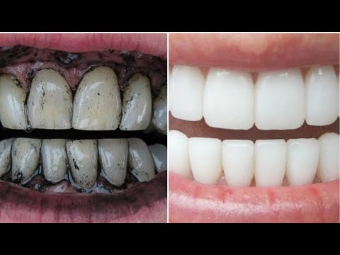 कितने भी गंदे पिले दांतों मोती सा चमकदार बनाना देता है ये फ्री का उपाय || teeth whitening