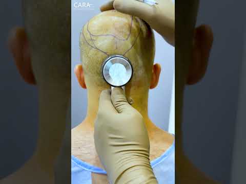 The Ultimate Hairline Transformation at Cara Clinic